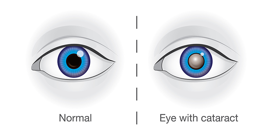 Comparison image of two eyes: one eye without a cataract, showing a clear central pupil, and the other eye with a cataract, showing a cloudy and obstructed central area