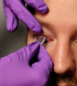 Male dry eye patient has a Prokera placed by a doctor wearing purple latex gloves.
