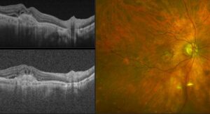 OCT image of wet macular degeneration on the left, displaying choroidal neovascularization. On the right, a color fundus photo of the macula showing signs of wet macular degeneration.