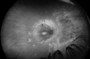 Black and white fundus autofluorescent image of a retina affected by dry macular degeneration, displaying characteristic changes in the macula region