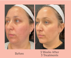 Before and After TriLift Treatment Results