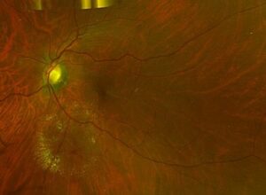 Retinal image showing signs of diabetic retinopathy, including microaneurysms, exudates, and hemorrhages.